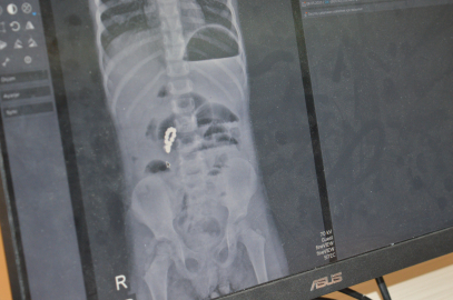 4 yaşındaki Eda’nın bağırsağından 8 adet mıknatıslı boncuk çıkarıldı